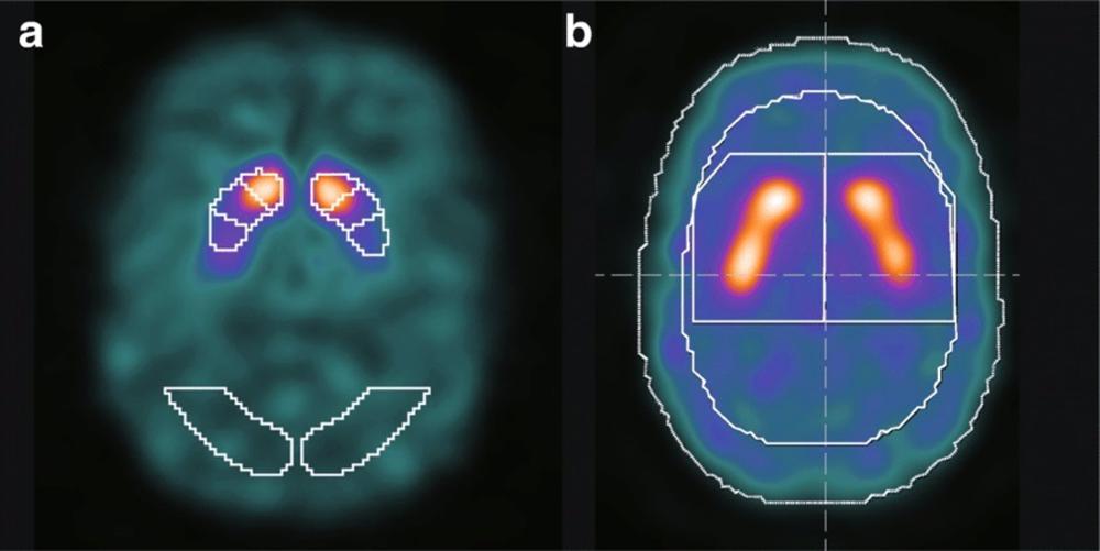 Los pacientes con Parkinson tienen pérdidas anuales superiores al 11% de las neuronas dopaminérgicas Los