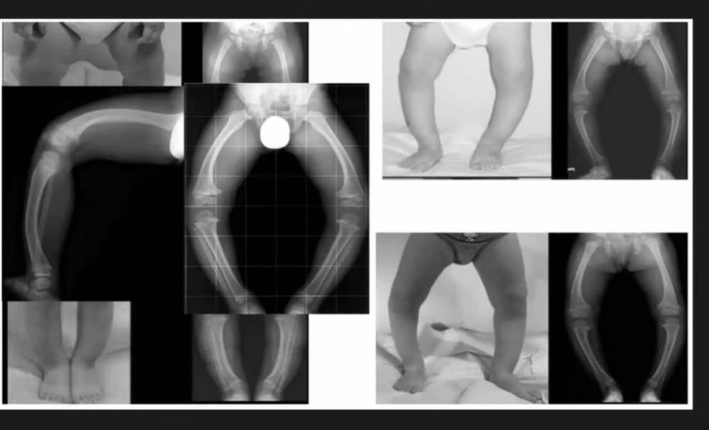 Archivo - Hipofosfatasia Archivo