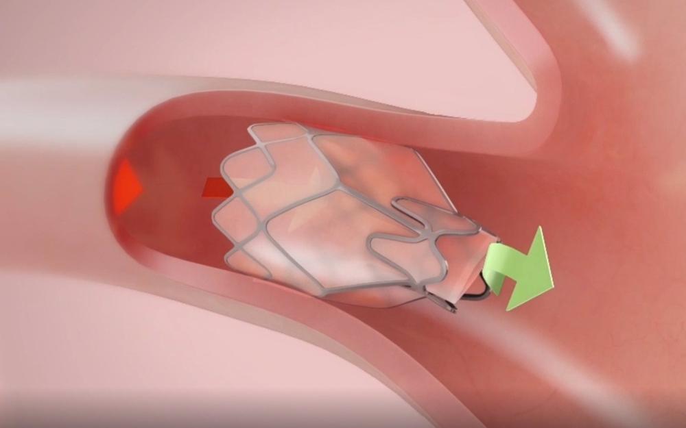 Valvula_zephyr Valvula_zephyr"