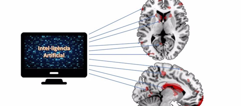 La resonancia magnética podría predecir el riesgo de recaída después de un primer brote psicótico La