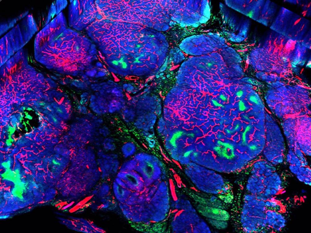 Mama con presencia de células cancerígenas HER2 positiva./ Mama