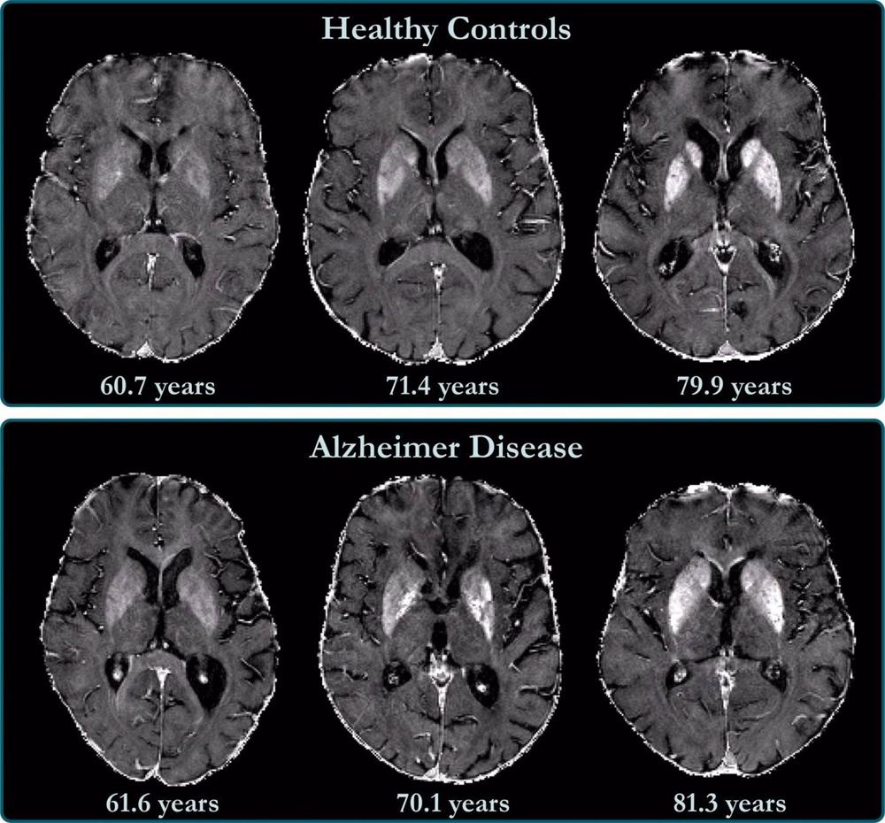 Archivo - La acumulación de hierro en el cerebro está relacionada con el deterioro cognitivo en pacientes con Alzheimer. Archivo