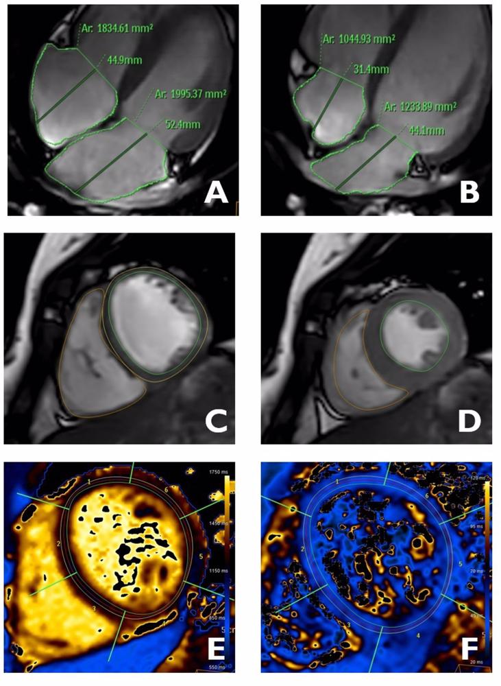 Imágenes del corazón obtenidas mediante resonancia magnética en las que se analizan distintas estructuras de la anatomía y función del corazón: aurículas (A y B), ventrículos (C y D), características del tejido cardiaco (E y F). Imágenes