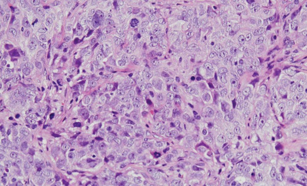 Cáncer