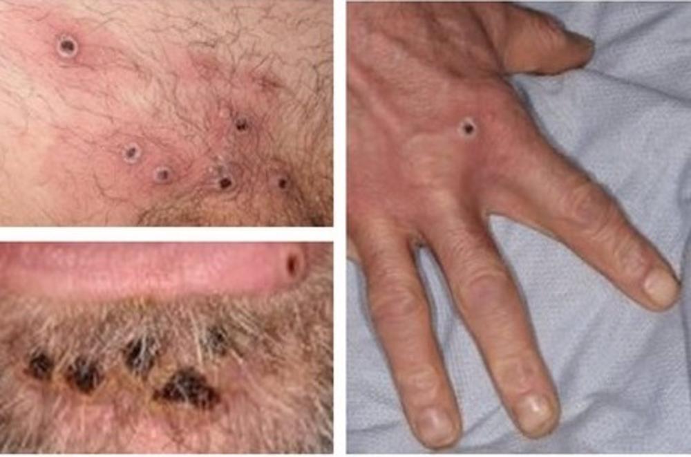 Archivo - Viruela del mono Archivo